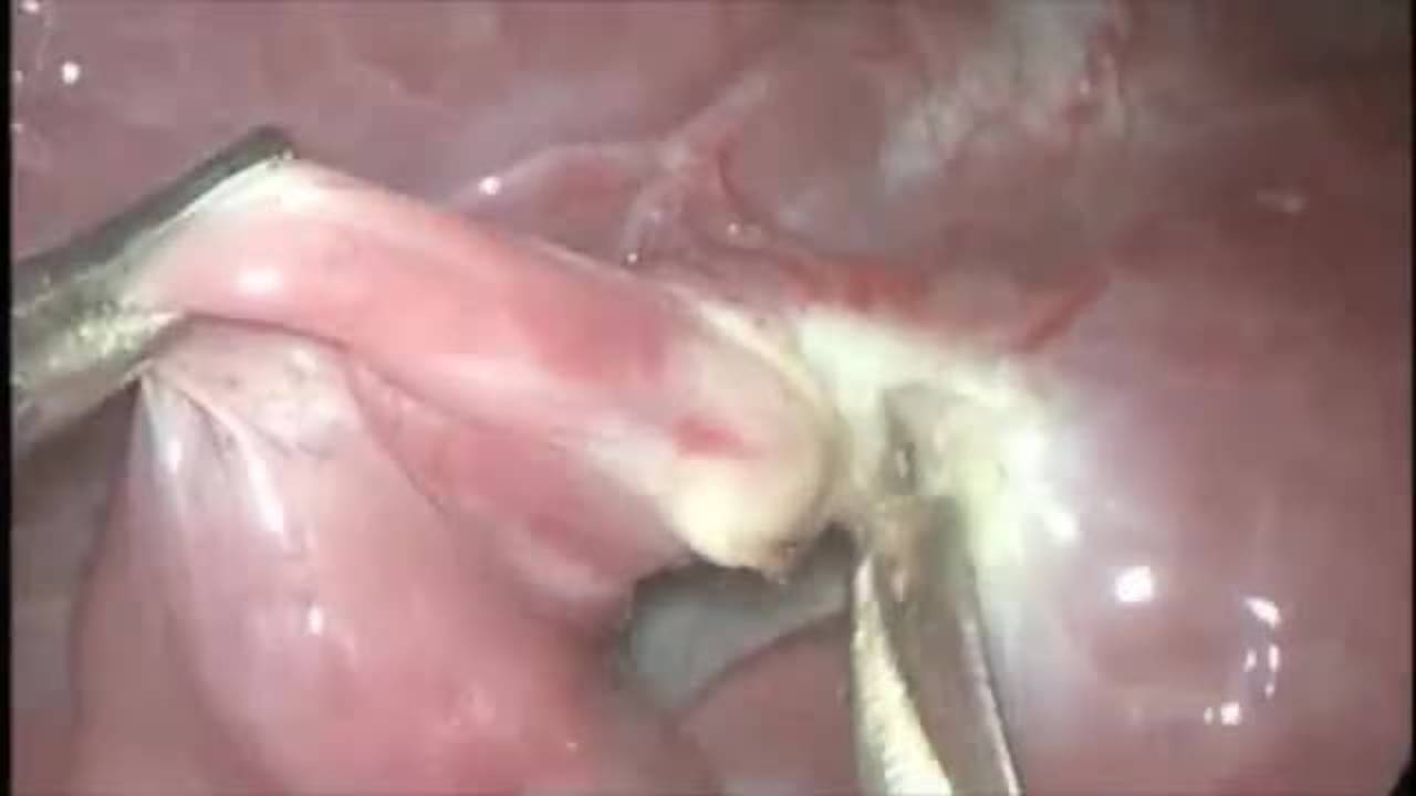 Technique: Blinded Left Upper Lobectomy