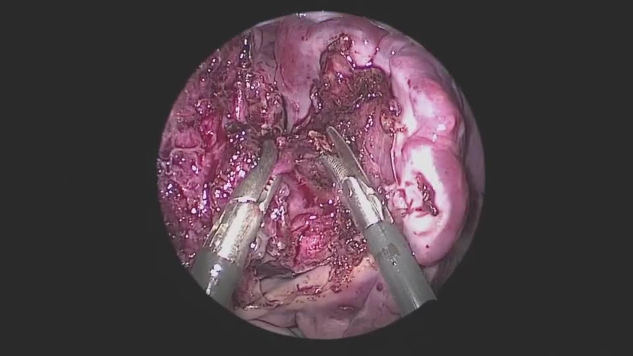 Technique: Right Middle Lobectomy