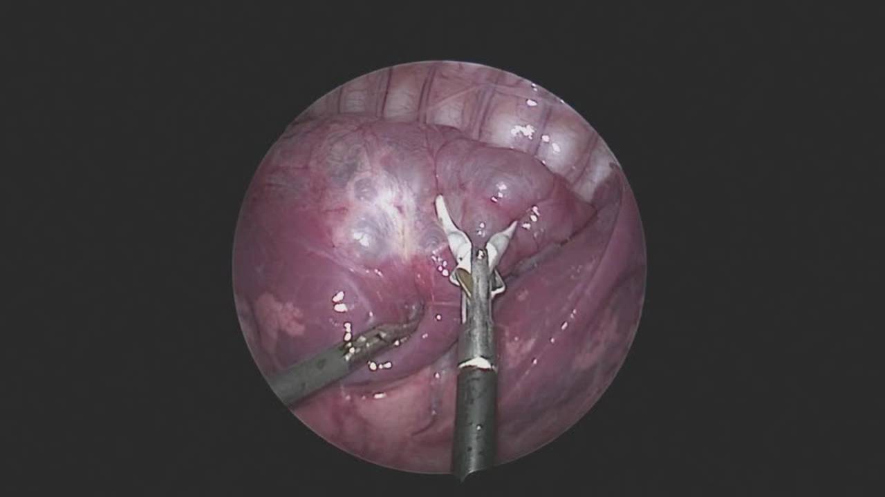 Technique: Right Lower Lobectomy