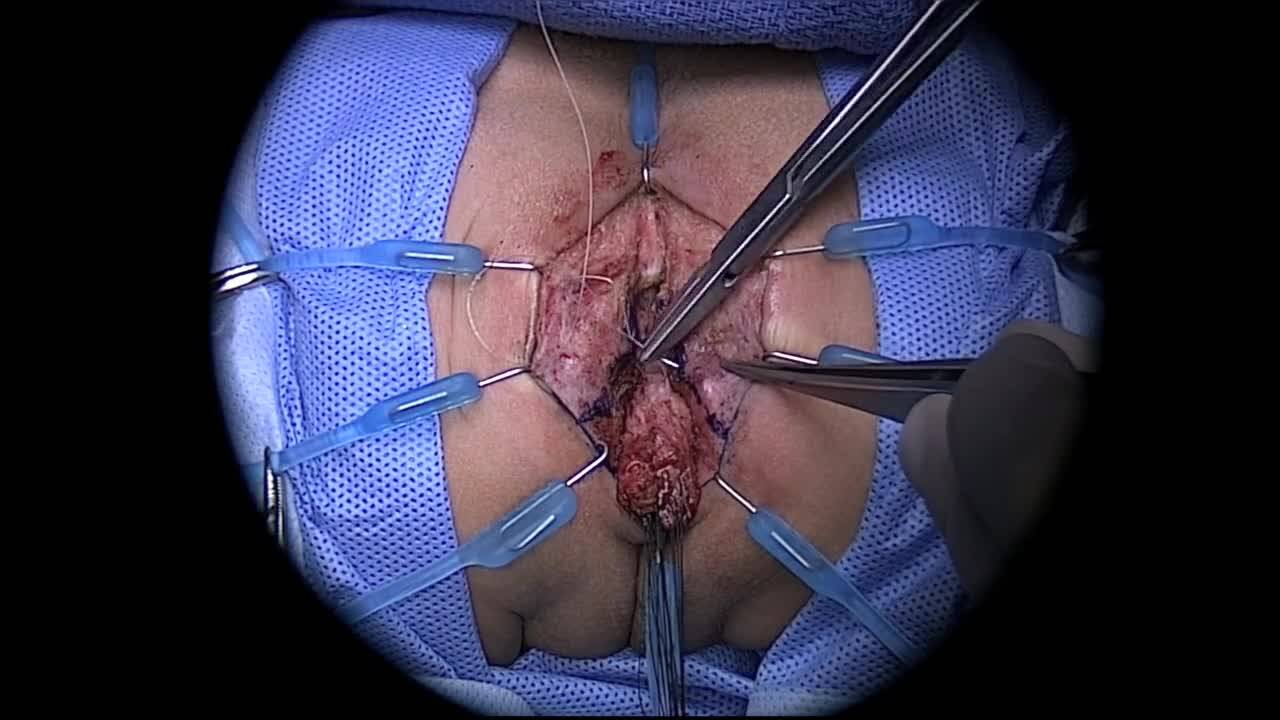Technique: PSARP in female with no fistula