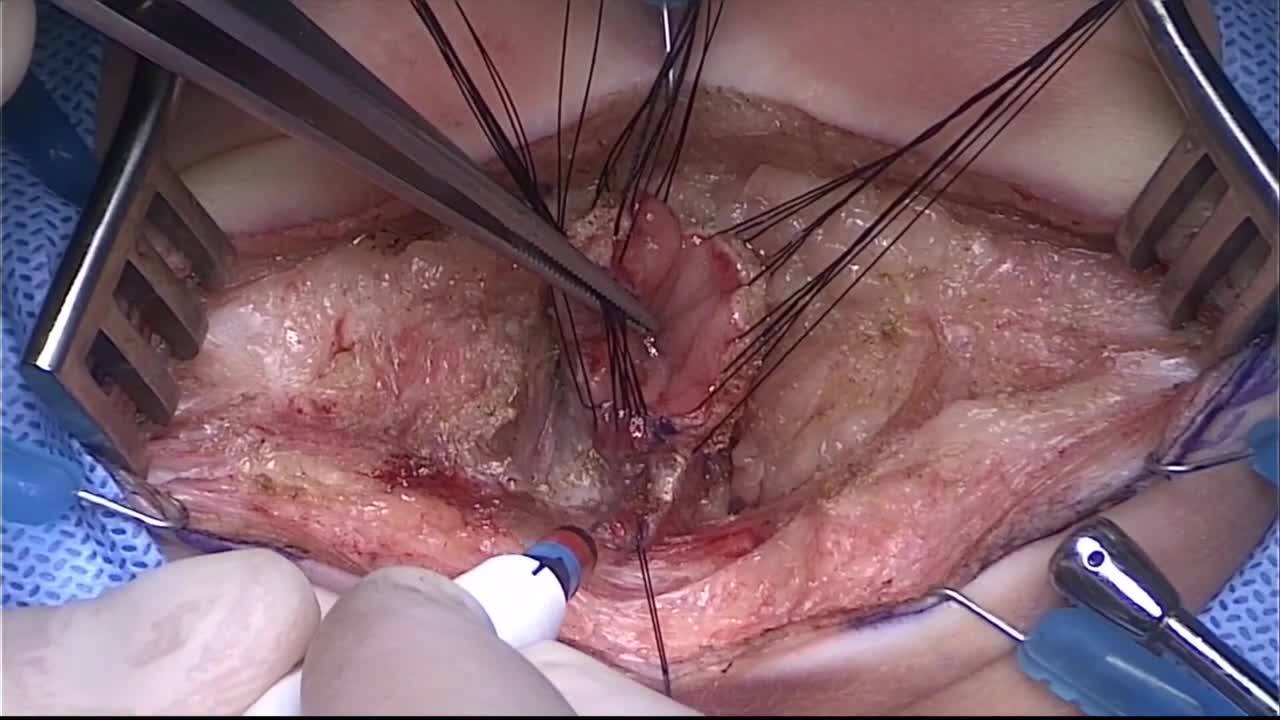 Technique: PSARP in Male with Rectobulbar Fistula