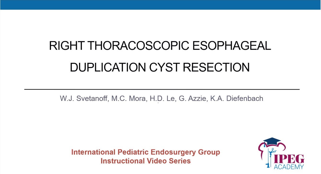IPEG Academy: Right Thoracoscopic Esophageal Duplication Cyst Resection