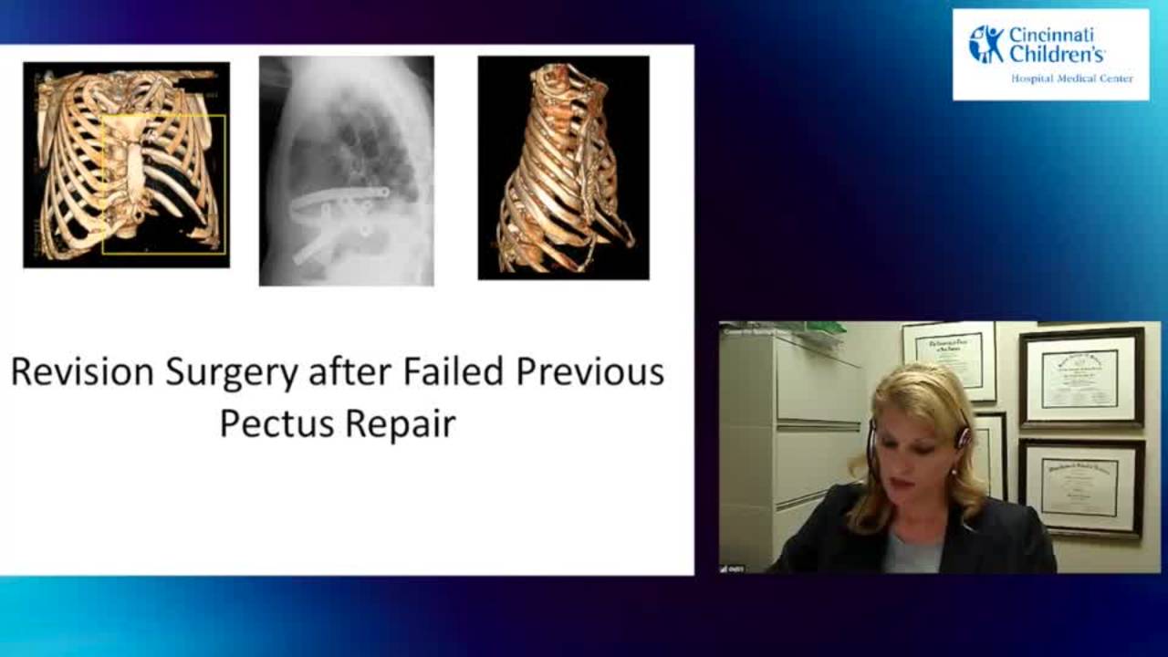 Interesting Cases & Surgical Approaches: Pectus Innovations