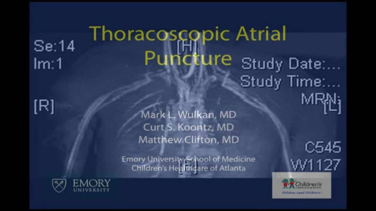 Technique: Thoracoscopic Atrial Puncture by Mark Wulkan, MD