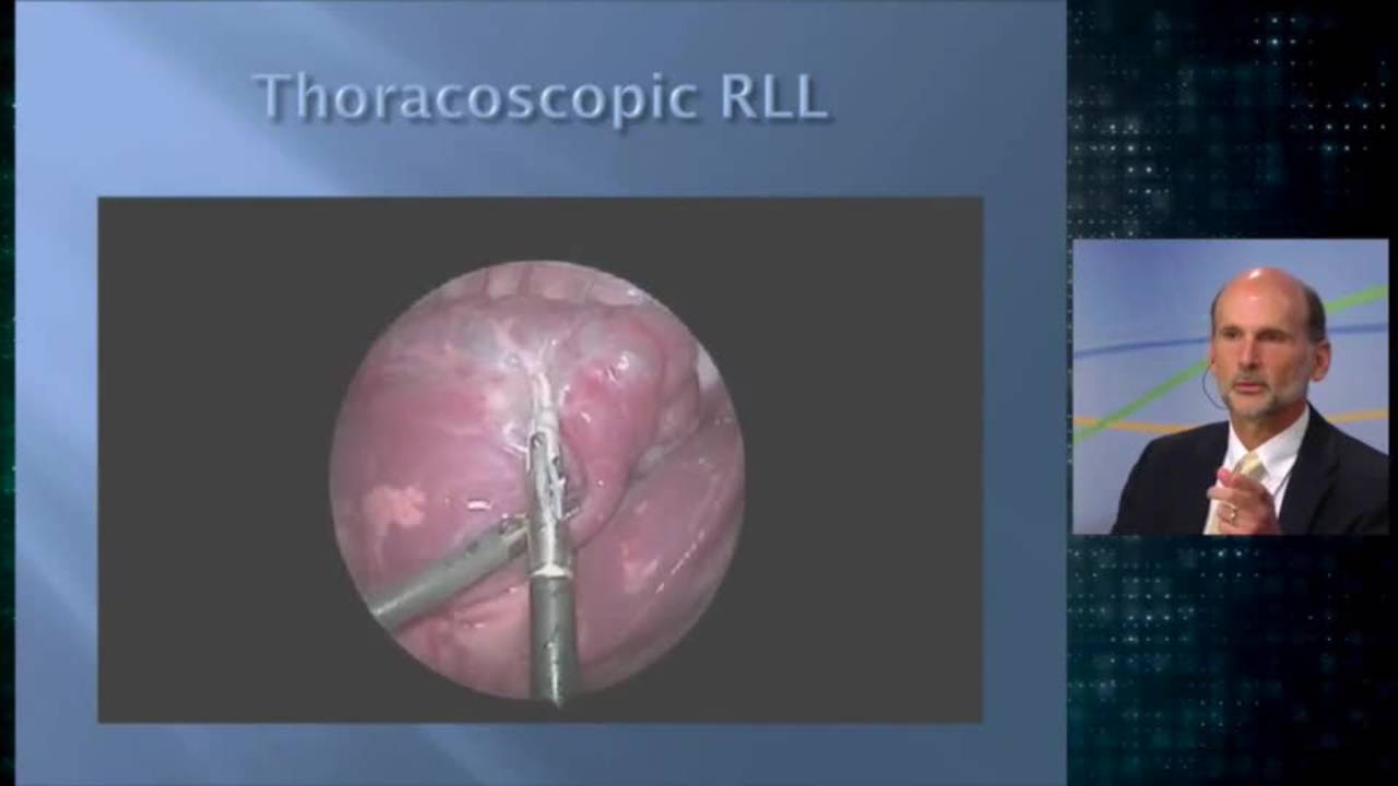 Thoracoscopic Right Lower Lobe Cystic Lesion Excision: Update Course 2014
