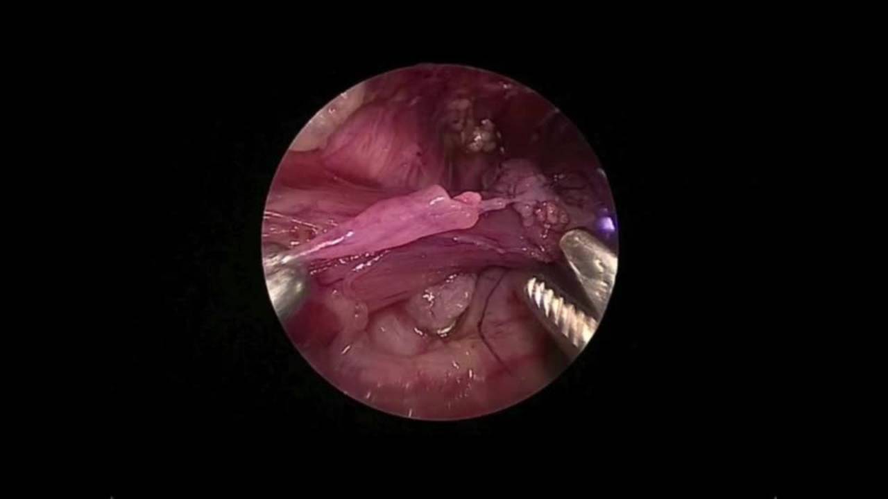 EA/TEF Discussion & Technique: Difficult Cases