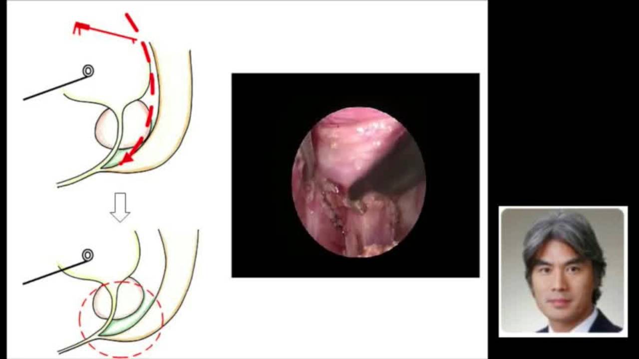 Imperforate Anus & Rectourethral Fistula Technique & Discussion: Difficult Cases