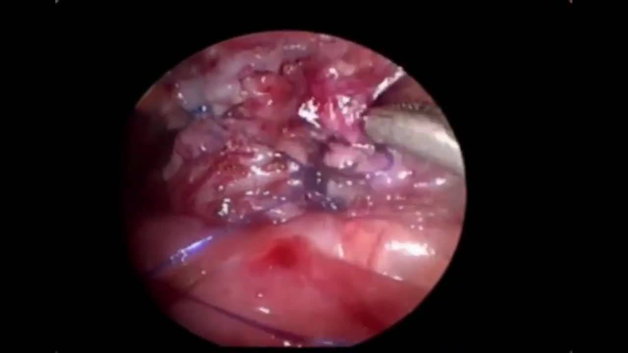 Long Gap Technique Videos: EA & TEF