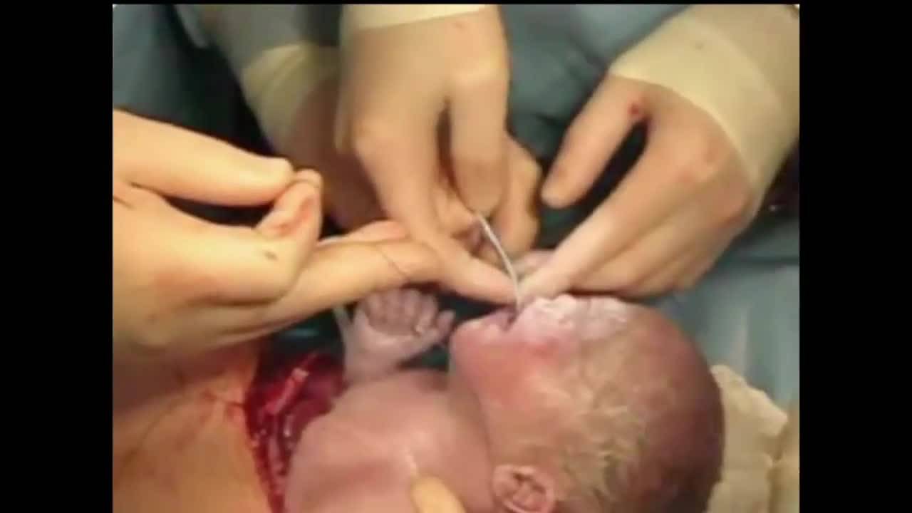 Prenatal Management of CPAMs: Lung Lesions