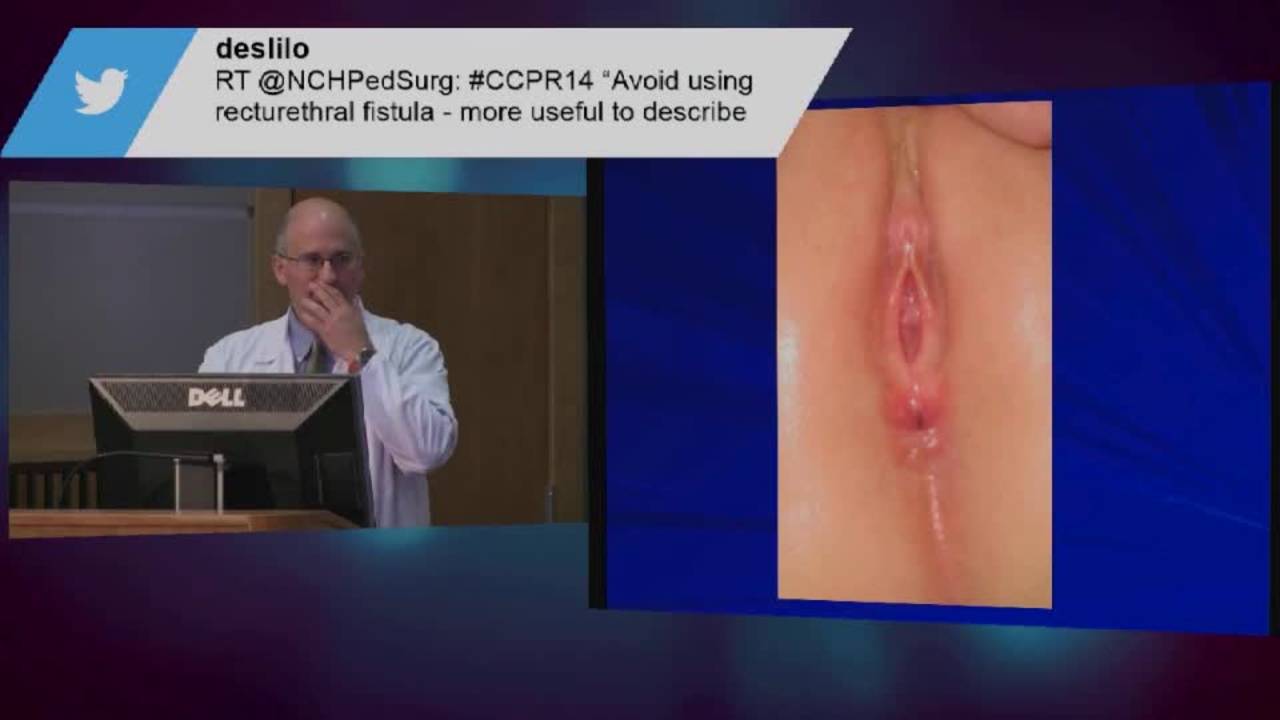 Anorectal Malformation Management of Female Patients Part I: Pediatric...