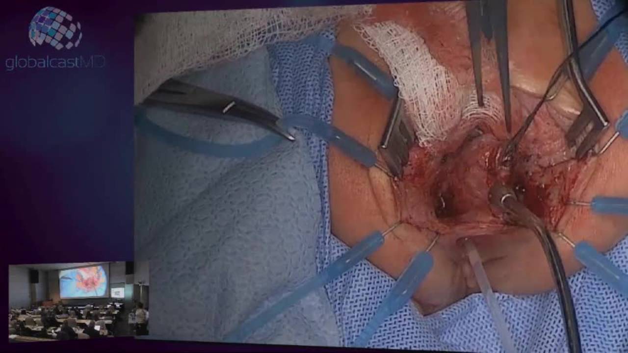 Posterior Sagittal Anorectaplasty-Female Part II: Pediatric Colorectal...