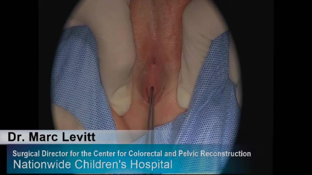 Posterior Sagittal Anorectaplasty in a Female: Pediatric Colorectal...