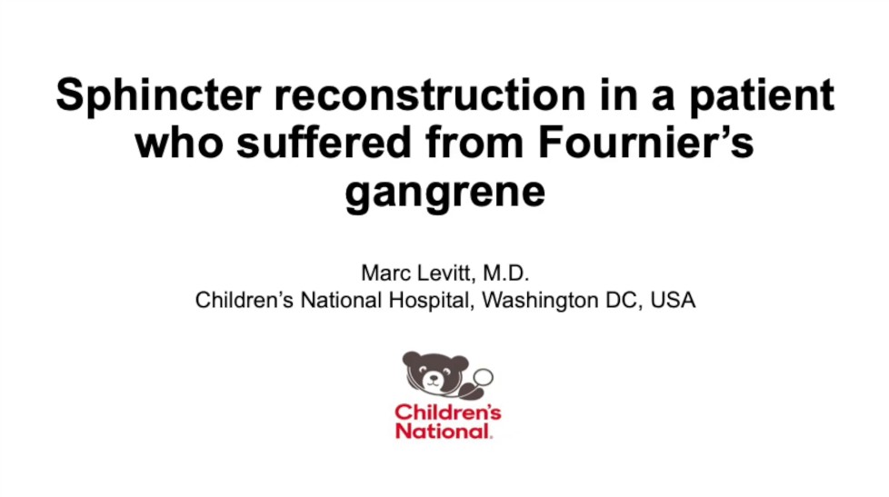 Sphincter Reconstruction in a patient who suffered from Fournier’s gangrene 