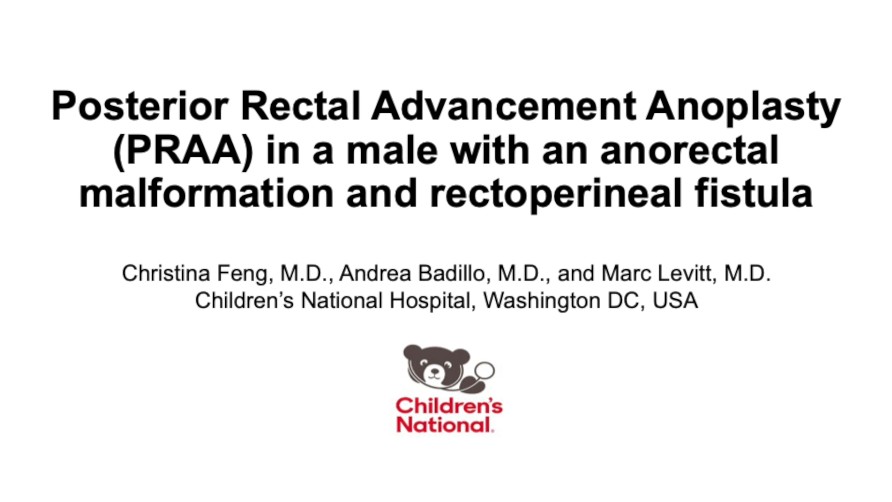Posterior Rectal Advancement Anoplasty (PRAA) in a male with an anorectal malformation and rectoperineal fistula 