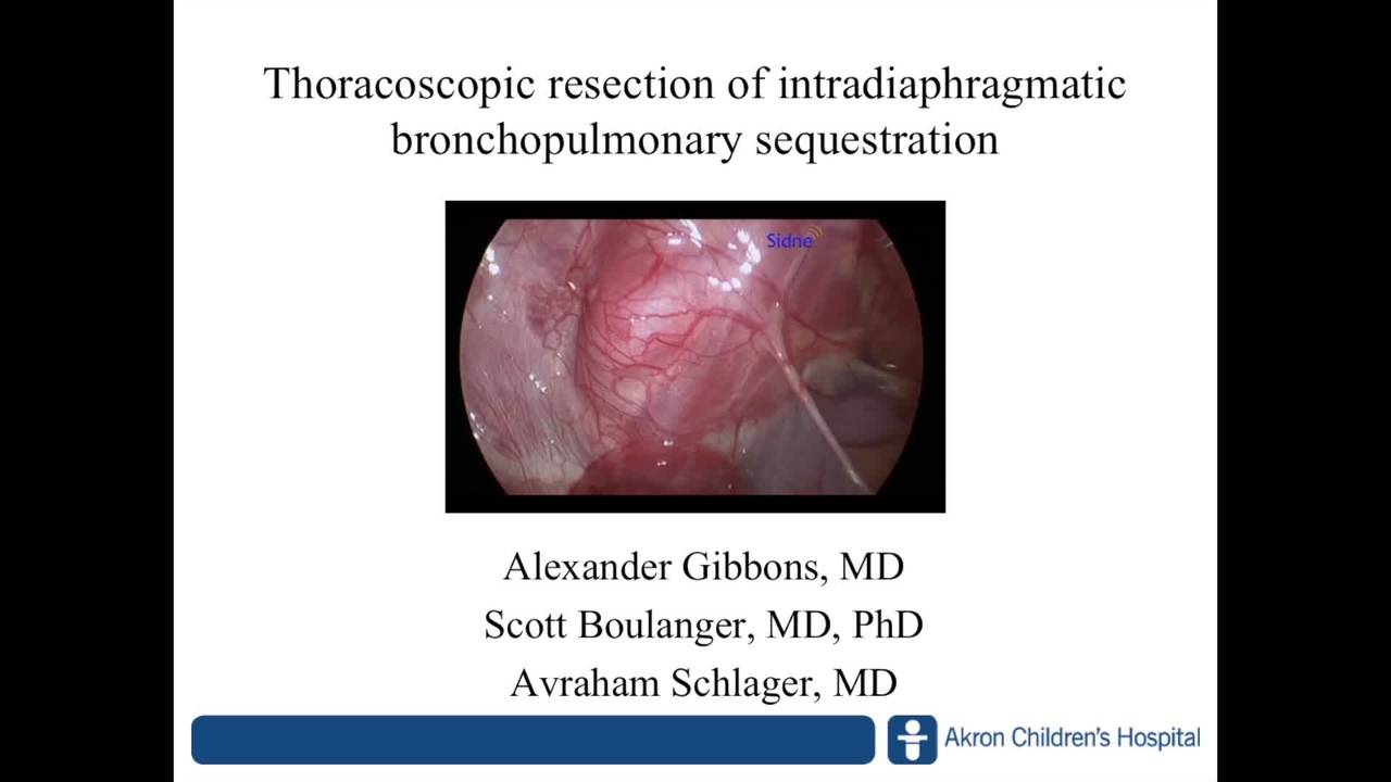 Thoracoscopic resection of intradiaphragmatic bronchopulmonary sequestration