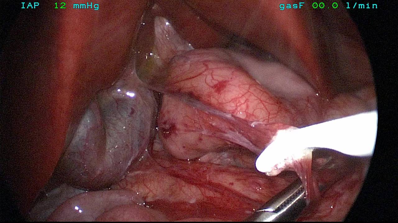 Duodenal Atresia Repair by Dr. Karen Diefenbach.mp4