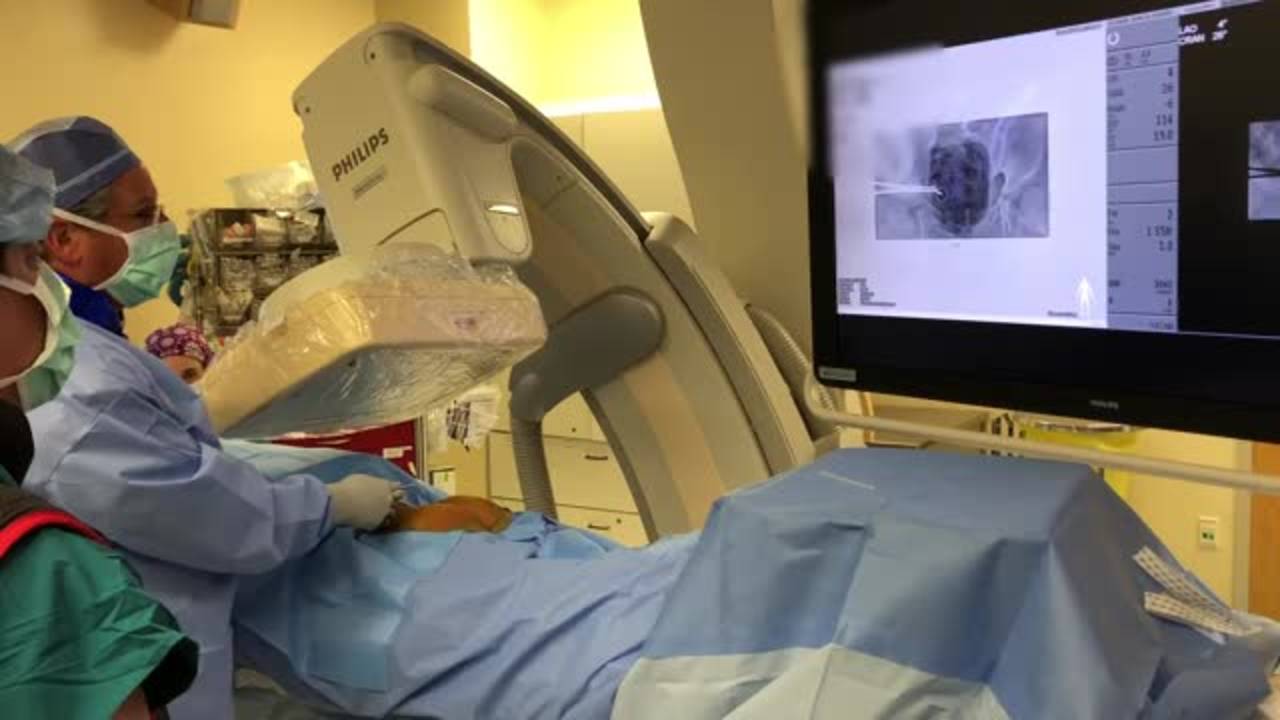 Sacral Nerve Stimulator Placement: A Novel Surgical Navigation Tool for...