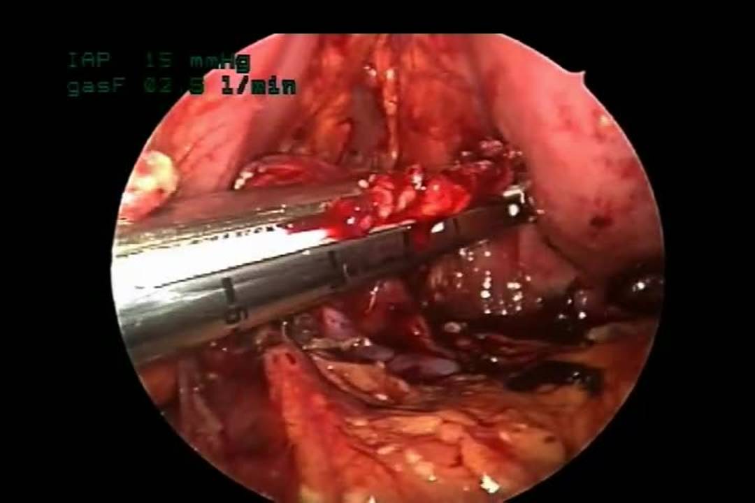 Laparoscopic Distal Pancreatectomy for Traumatic Transection
