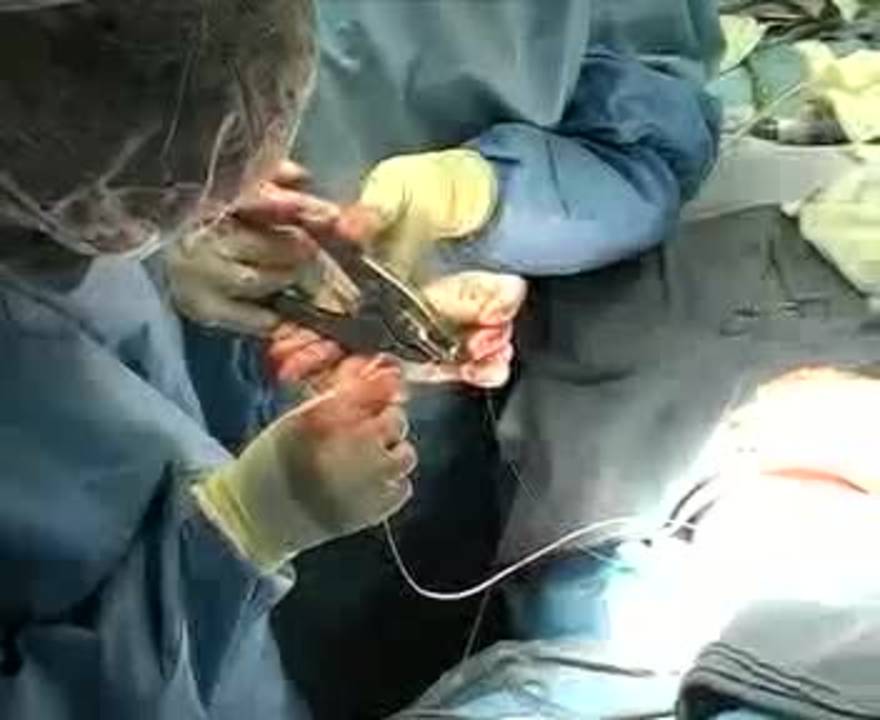 Minimally Invasive Repair of Pectus Carinatum