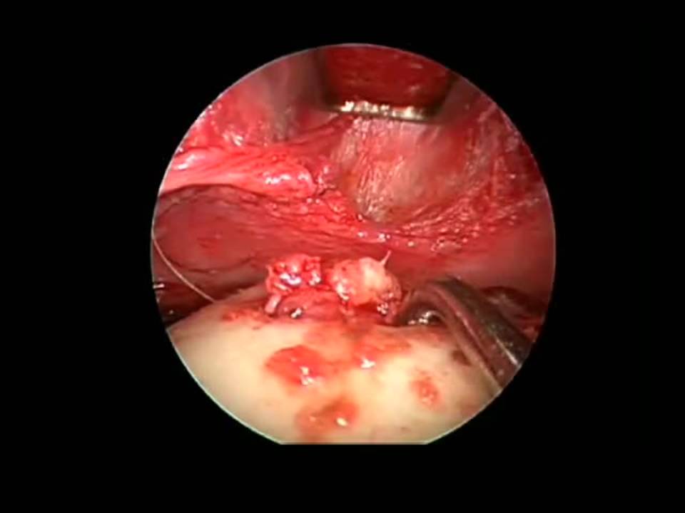 Endoscopic-guided Excision of a Midline Forehead Dermoid