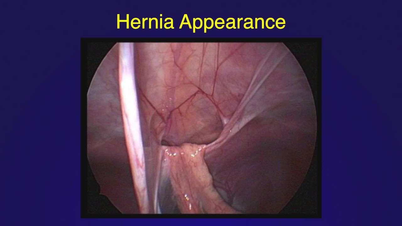 Laparoscopic-assisted Repair of Morgagni Hernia