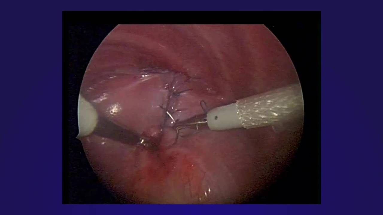 Thoracoscopic Repair of Left Bochdalek Hernia