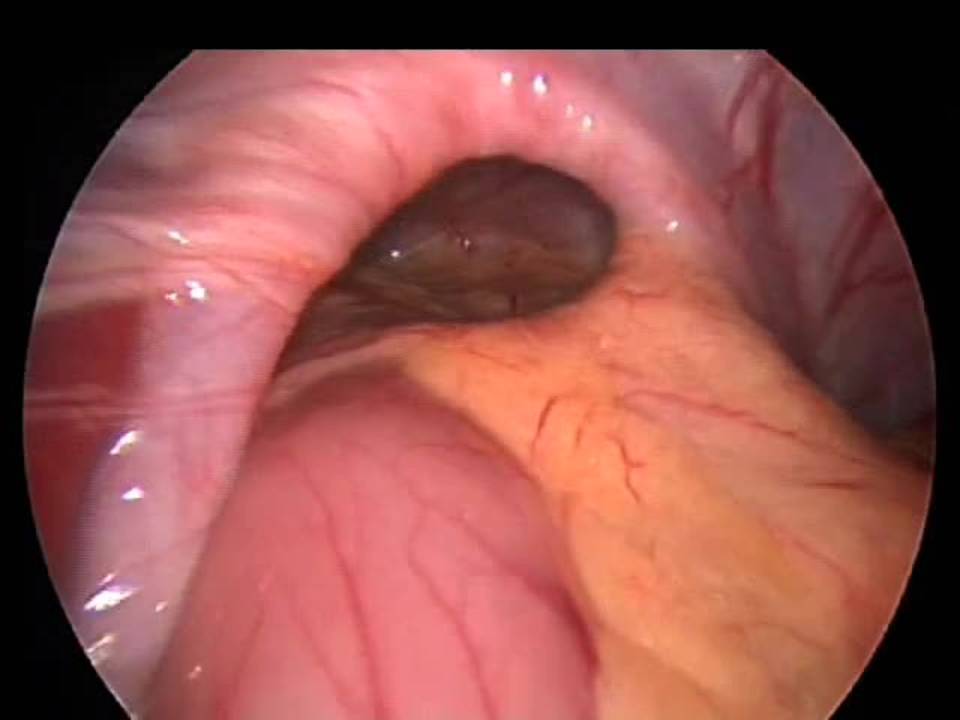 Laparoscopic Repair of Paraesophageal Hernia