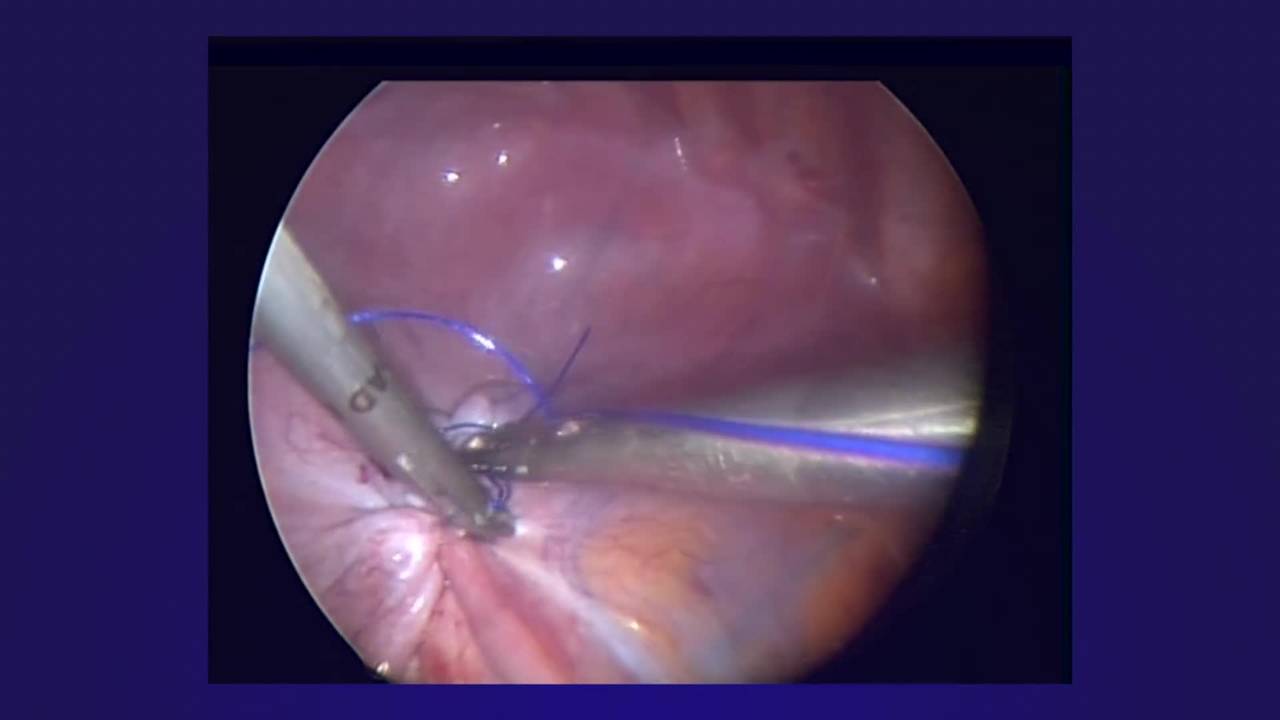 Thoracoscopic Diaphragmatic Plication