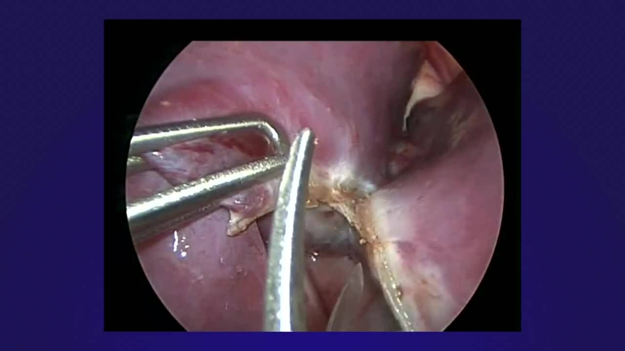 Thoracoscopic Left Lower Lobectomy for Congenital Pulmonary Airway Malformation