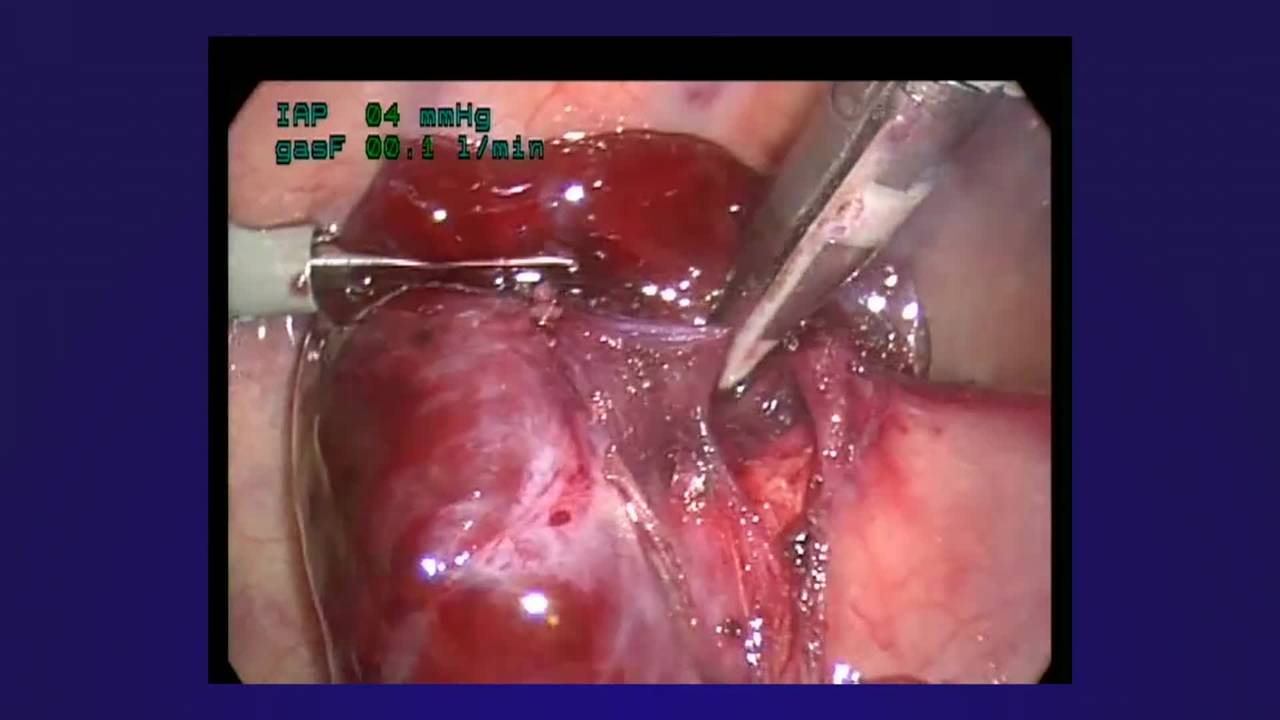 Thoracoscopic Resection of Extralobar Bronchopulmonary Sequestration