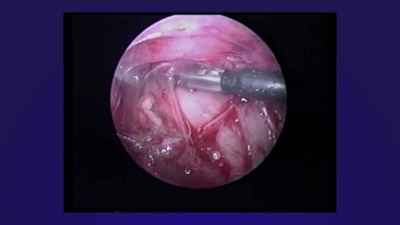 Thoracoscopic Resection of Bronchopulmonary Foregut Malformation