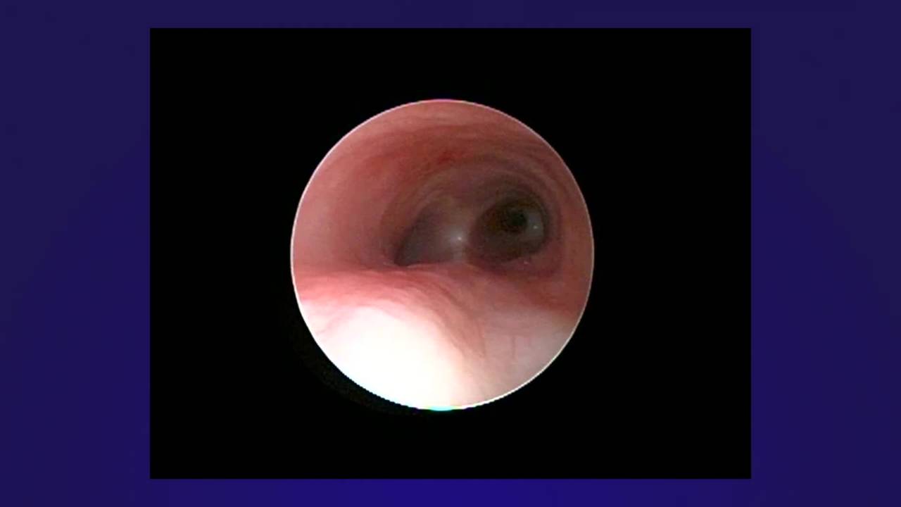 Rigid Bronchoscopy for Diagnosis and Treatment of Proximal Pouch Fistula in...