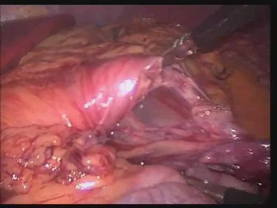 Laparoscopic Excision of an Abdominal Lymphatic Malformation