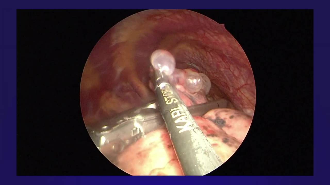 Thoracoscopic Treatment of Spontaneous Pneumothorax