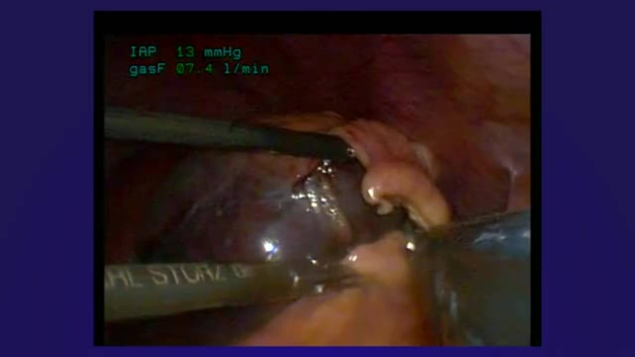 Laparoscopic Partial Splenectomy for Splenic Cyst