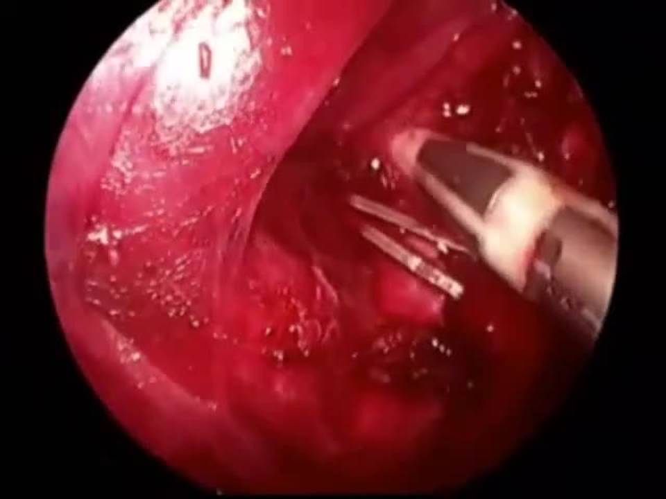Thoracoscopic Upper Lobectomies for Symptomatic Congenital Pulmonary Airway...
