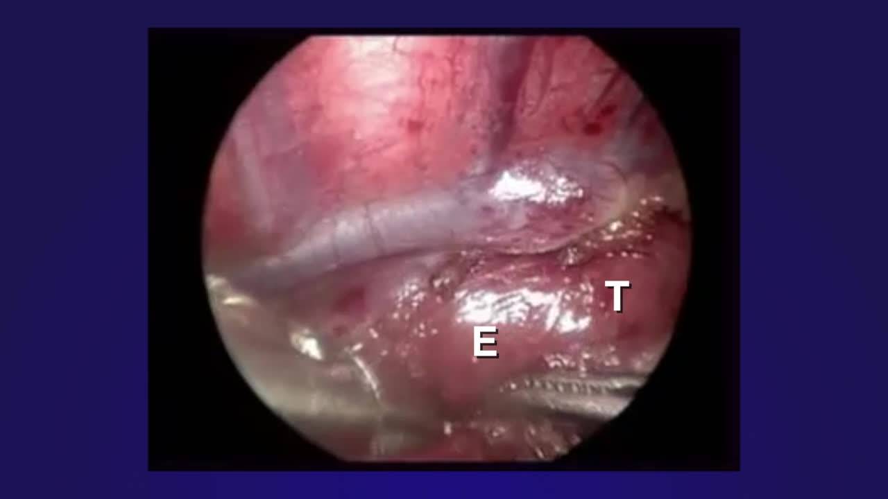 Thoracoscopic Repair of Esophageal Atresia with Distal Tracheo-esophageal...