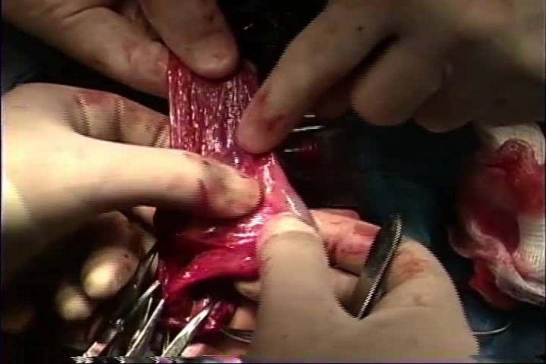 Laparoscopic-assisted Treatment of Abdominoscrotal Hydrocele
