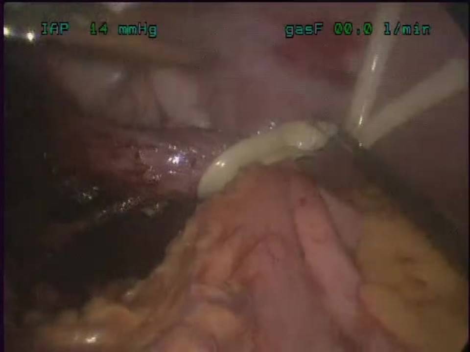 Laparoscopic Heller Myotomy