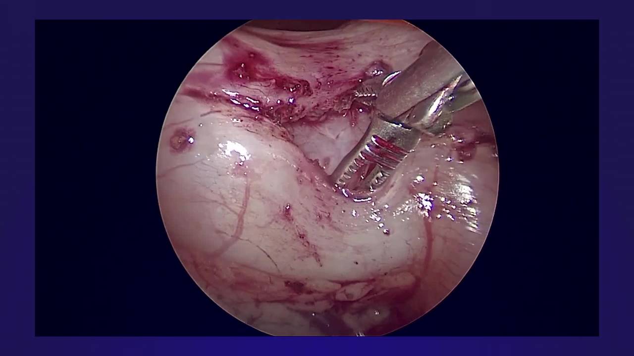 Laparoscopic Pyloromyotomy