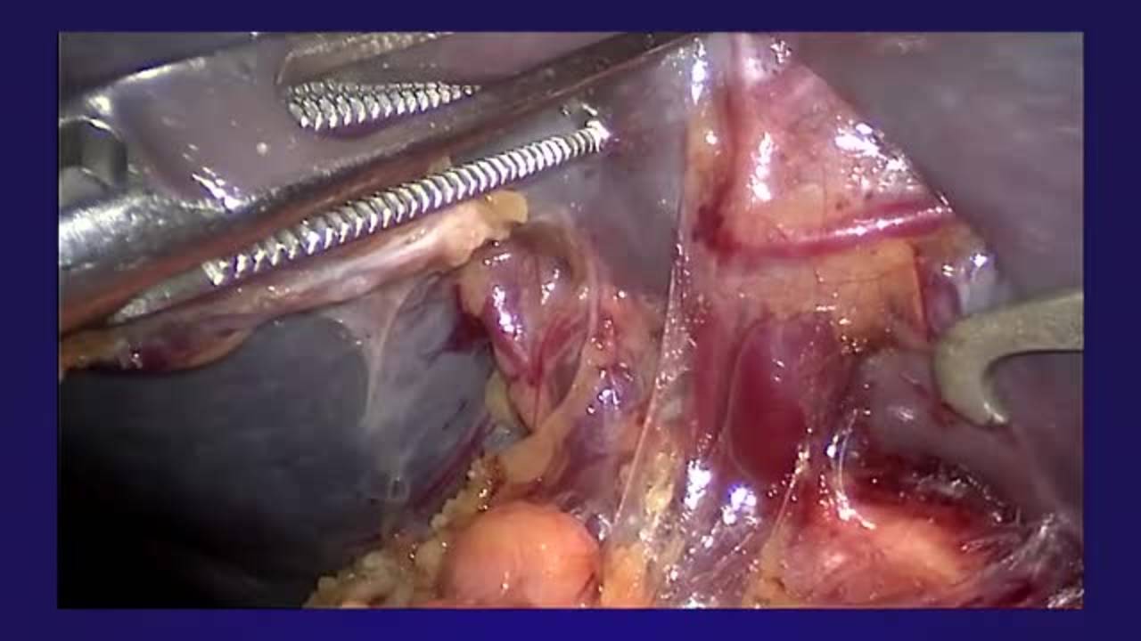 Laparoscopic Splenectomy and Cholecystectomy for Spherocytosis
