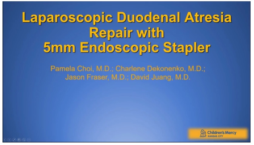 IPEG 2020 Top Abstract: Laparoscopic Duodenal Atresia Repair with 5mm Endoscopic Stapler