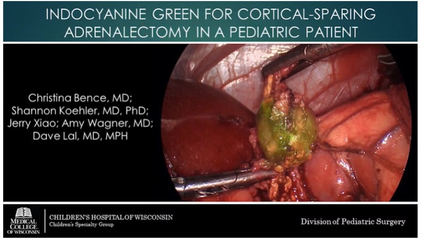 IPEG 2020 TOP ABSTRACT: Indocyanine Green for Cortical-Sparing Adrenalectomy in a Pediatric Patient