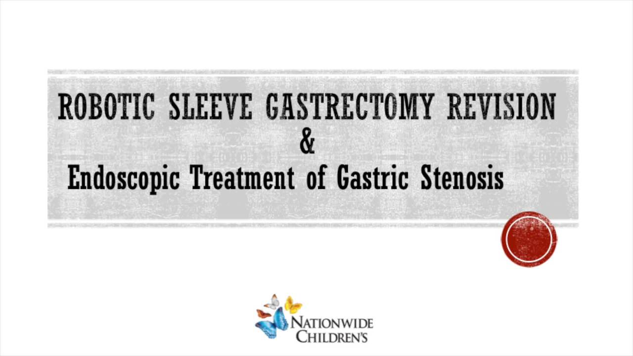 IPEG 2020 TOP ABSTRACT: Robotic-Assisted Sleeve Gastrectomy Revision and Endoscopic Treatment of Gastric Stenosis