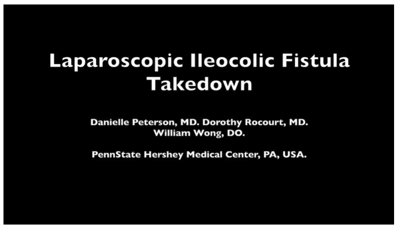 IPEG 2020 TOP ABSTRACT: Laparoscopic takedown of an ileocolic fistula.
