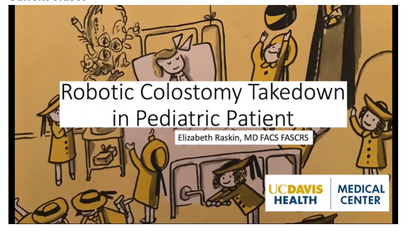 IPEG 2020 TOP ABSTRACT: Robotic Colostomy Takedown in a Pediatric Patient