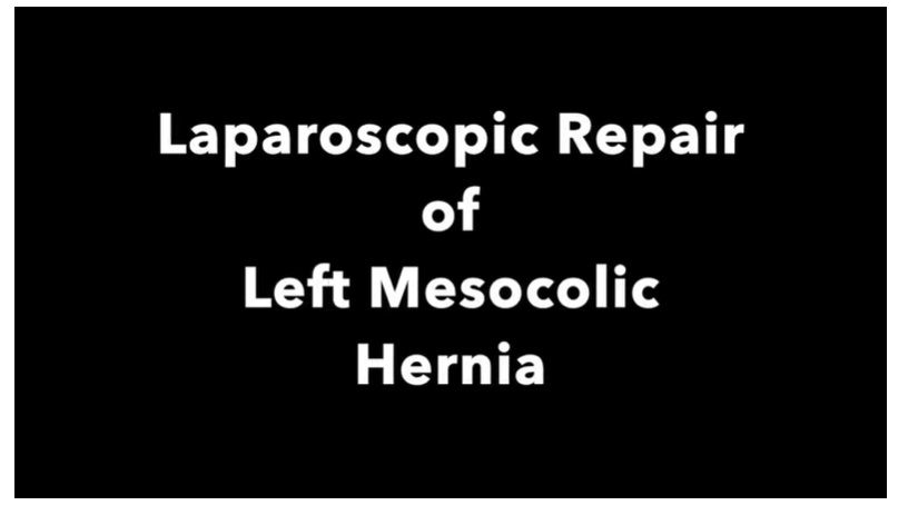 IPEG 2020 Top Abstract: Laparoscopic Left Mesocolic Hernia Repair