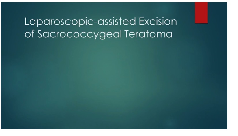 IPEG 2020 Top Abstract: Laparoscopic Assisted Excision of a Type III Sacrococcygeal Teratoma