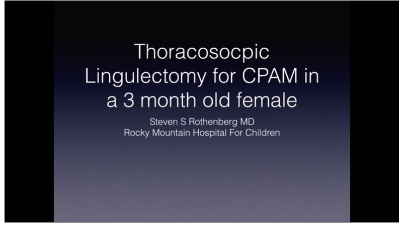 IPEG 2020 TOP ABSTRACT: Thoracoscopic lingulectomy for a Prenatally diagnosed CPAM in a 3 month old infant