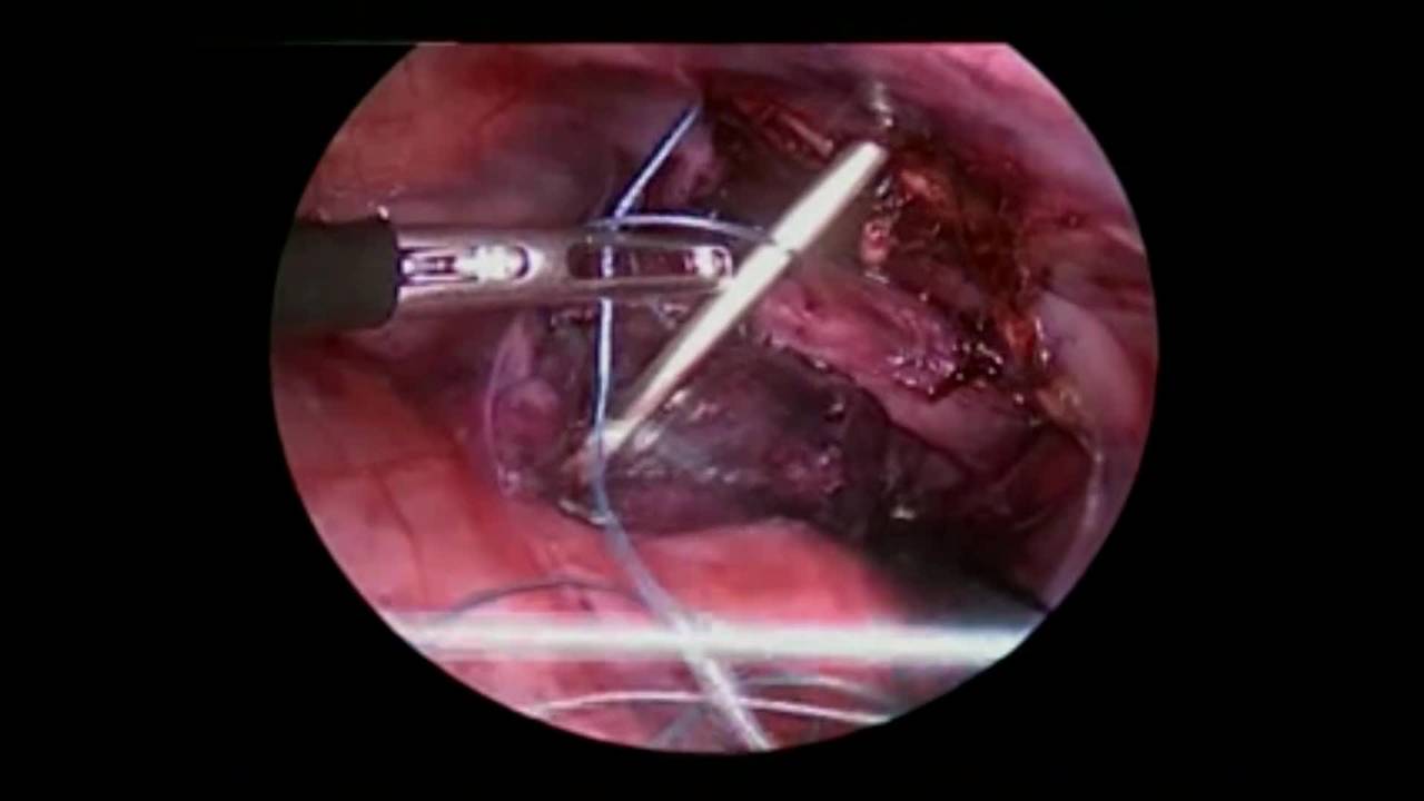 Thoracoscopic Aortopexy by, Dr. Carlos García Hernández.mp4